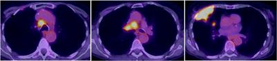 Case report: Secondary failure to tolvaptan in a patient with SCLC and paraneoplastic SIADH